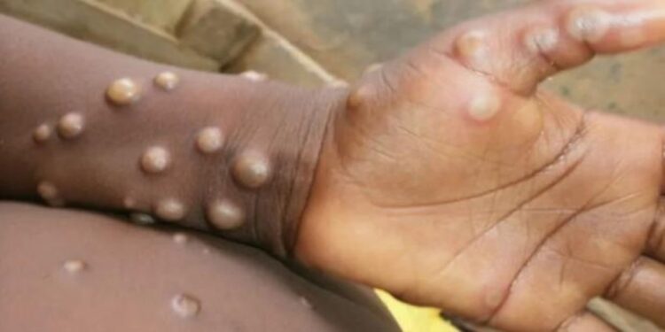 Hepatitis infantil y viruela del mono encienden alarmas mundiales