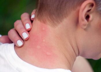 Burlan zancudos repelentes comerciales; urgen fumigaciones ante amenaza del dengue hemorrágico